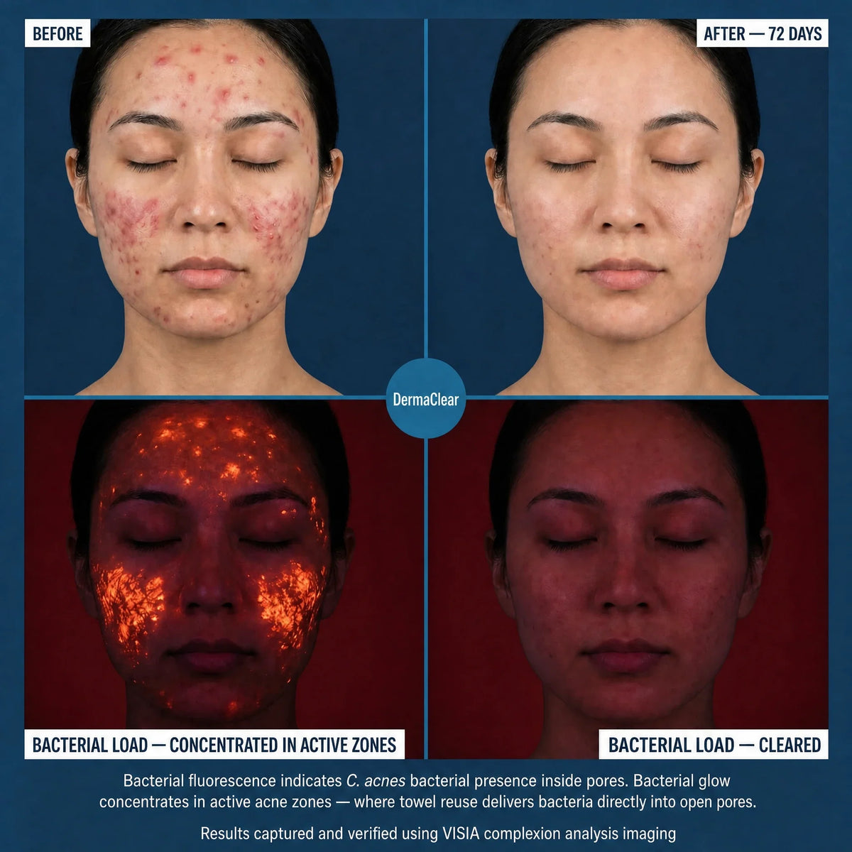 DermaClear™ Face Towels For Acne-Prone Skin