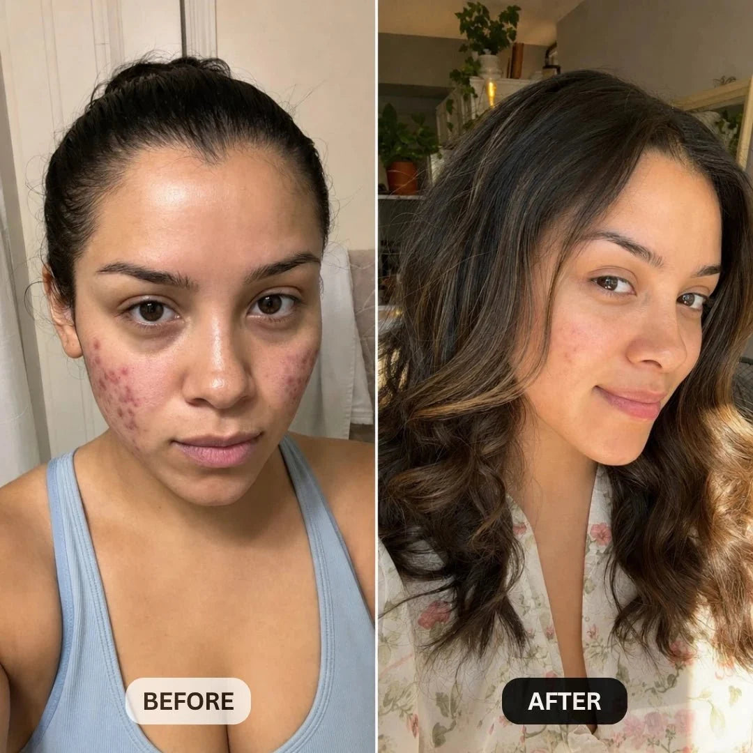 DermaClear™ Face Towels For Acne-Prone Skin