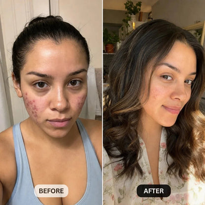 DermaClear™ Face Towels For Acne-Prone Skin