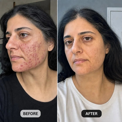 DermaClear™ Face Towels For Acne-Prone Skin