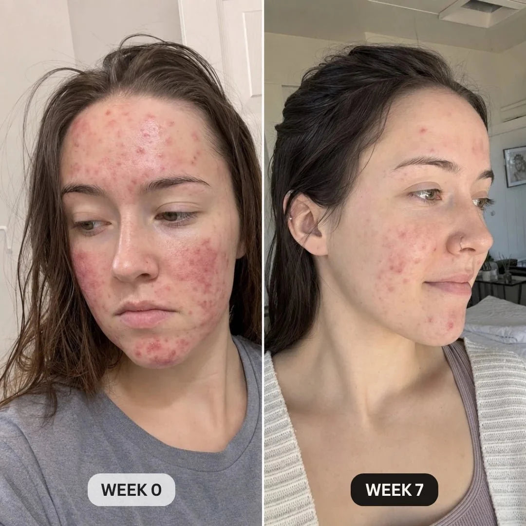 DermaClear™ Face Towels For Acne-Prone Skin
