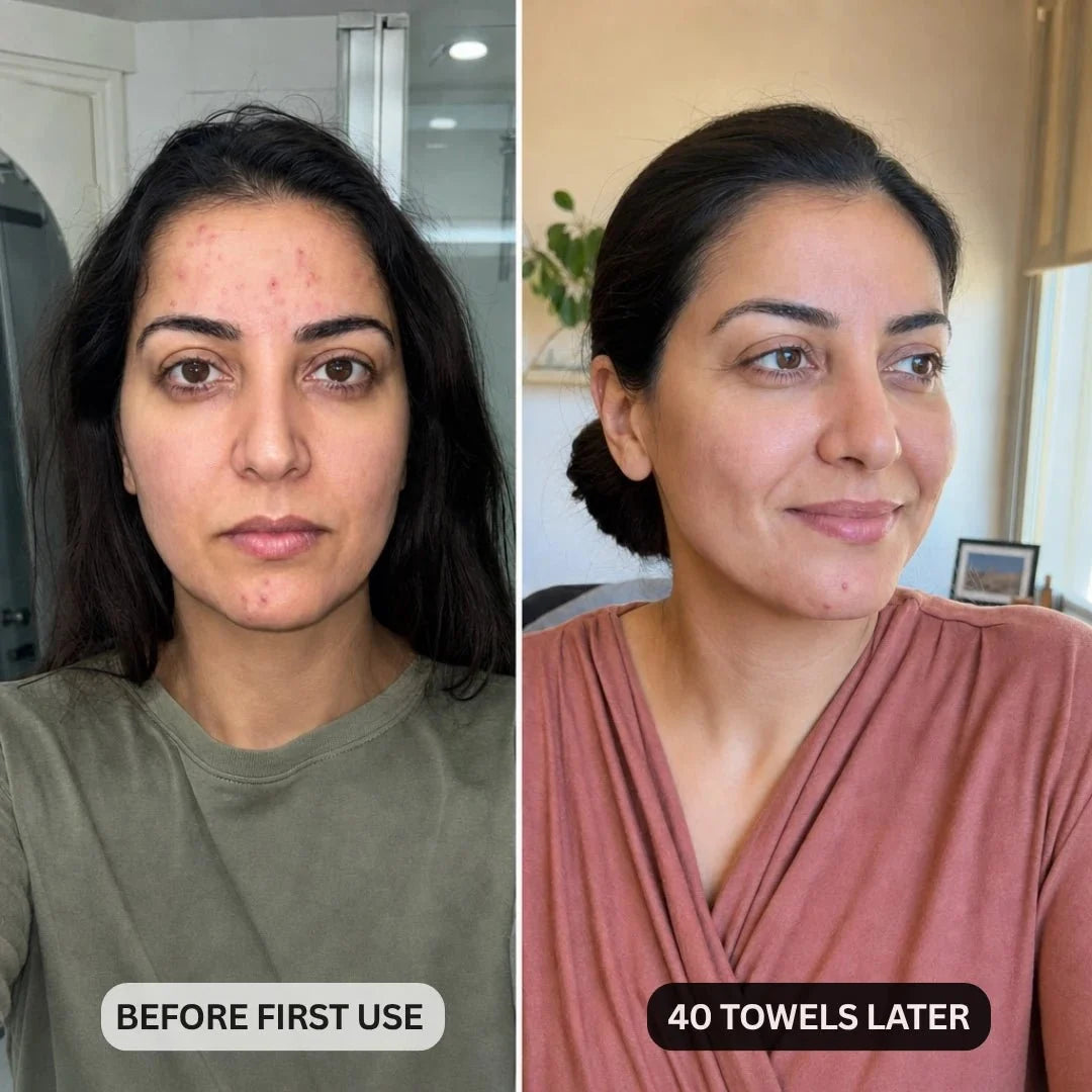 DermaClear™ Face Towels For Acne-Prone Skin