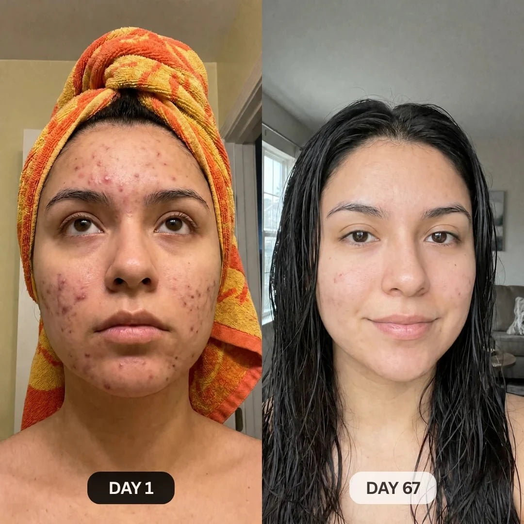 DermaClear™ Face Towels For Acne-Prone Skin