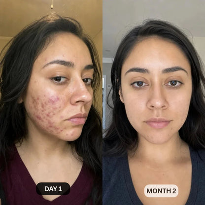 DermaClear™ Face Towels For Acne-Prone Skin