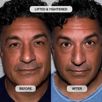 Micro-Infusion System For Hooded Eyelids for Men