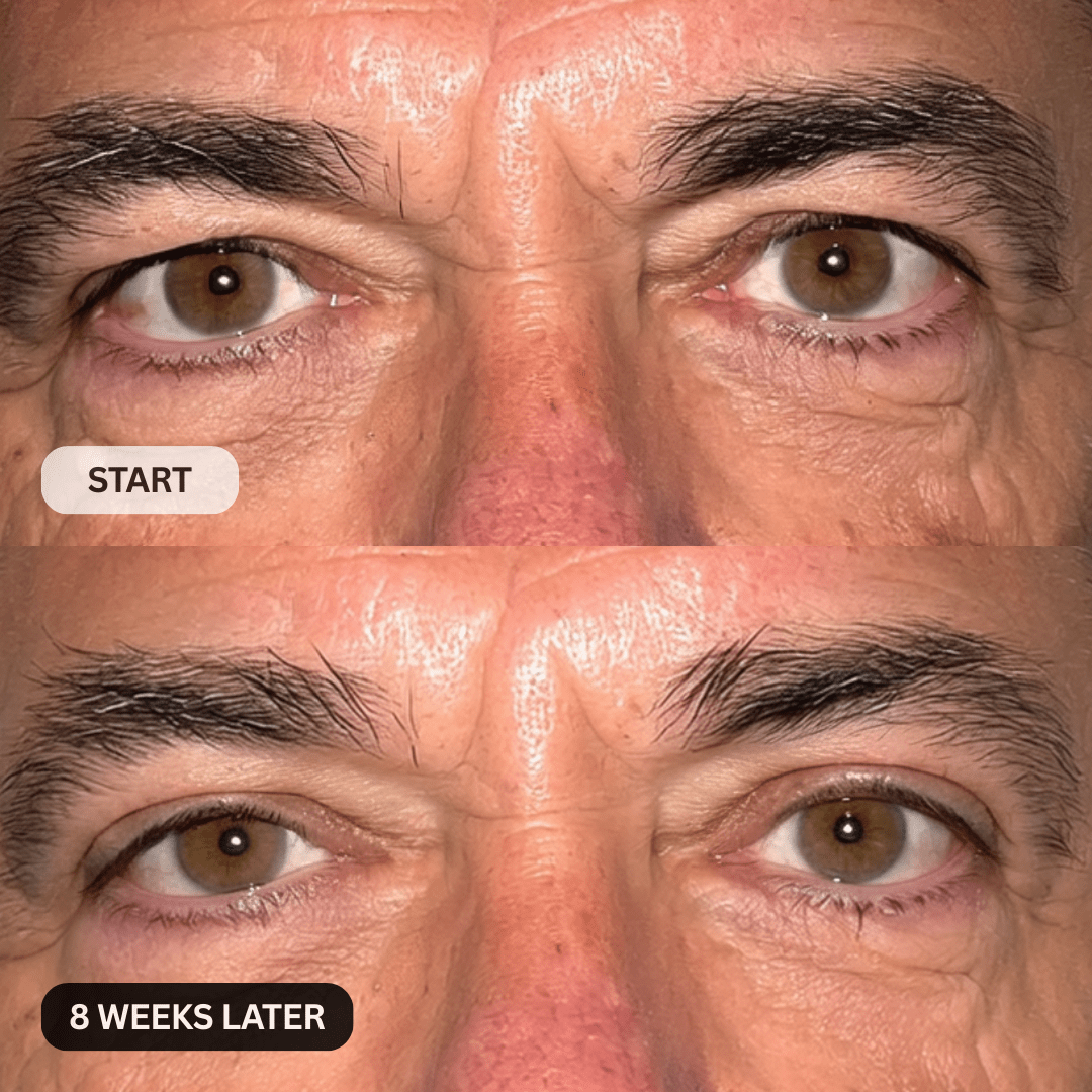 Micro-Infusion System For Hooded Eyelids for Men