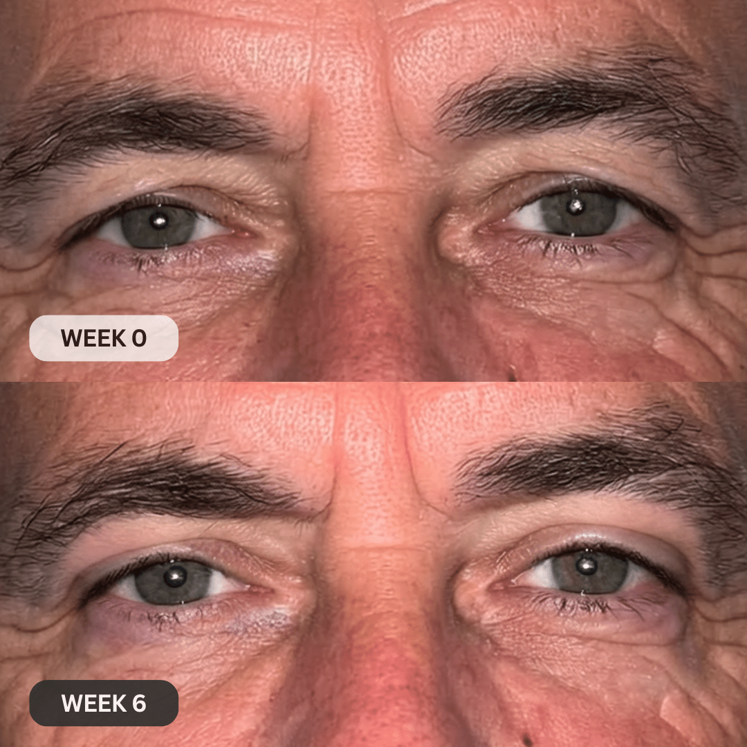 Micro-Infusion System For Hooded Eyelids for Men