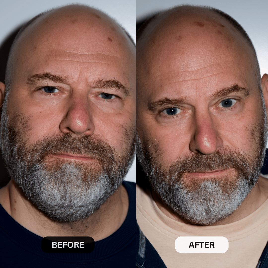 Micro-Infusion System For Hooded Eyelids for Men