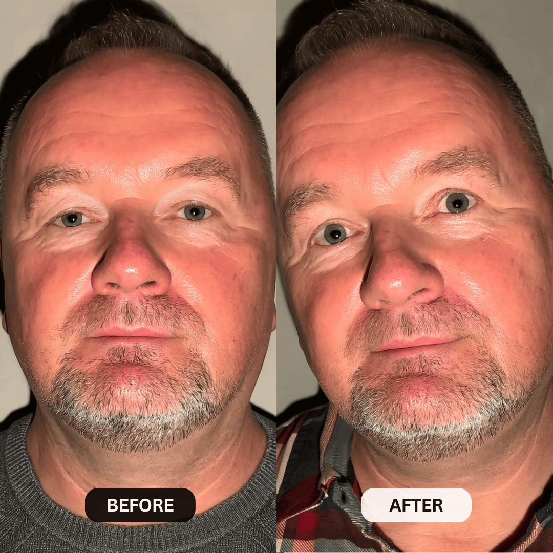 Micro-Infusion System For Hooded Eyelids for Men