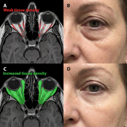 Micro-Infusion System For Eye Bags & Dark Circles
