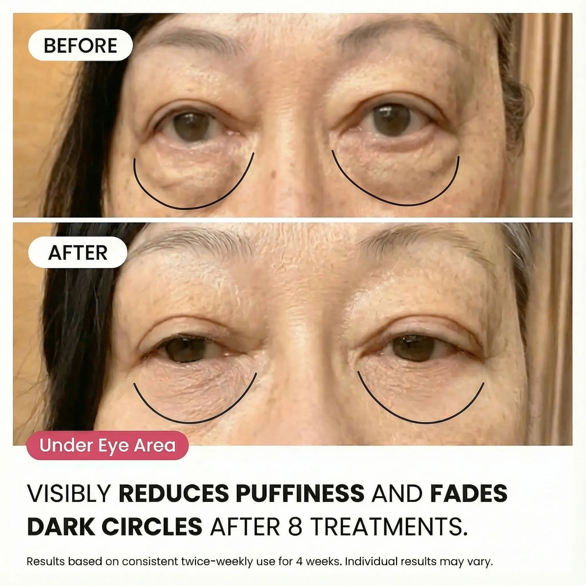 Micro-Infusion System For Eye Bags & Dark Circles