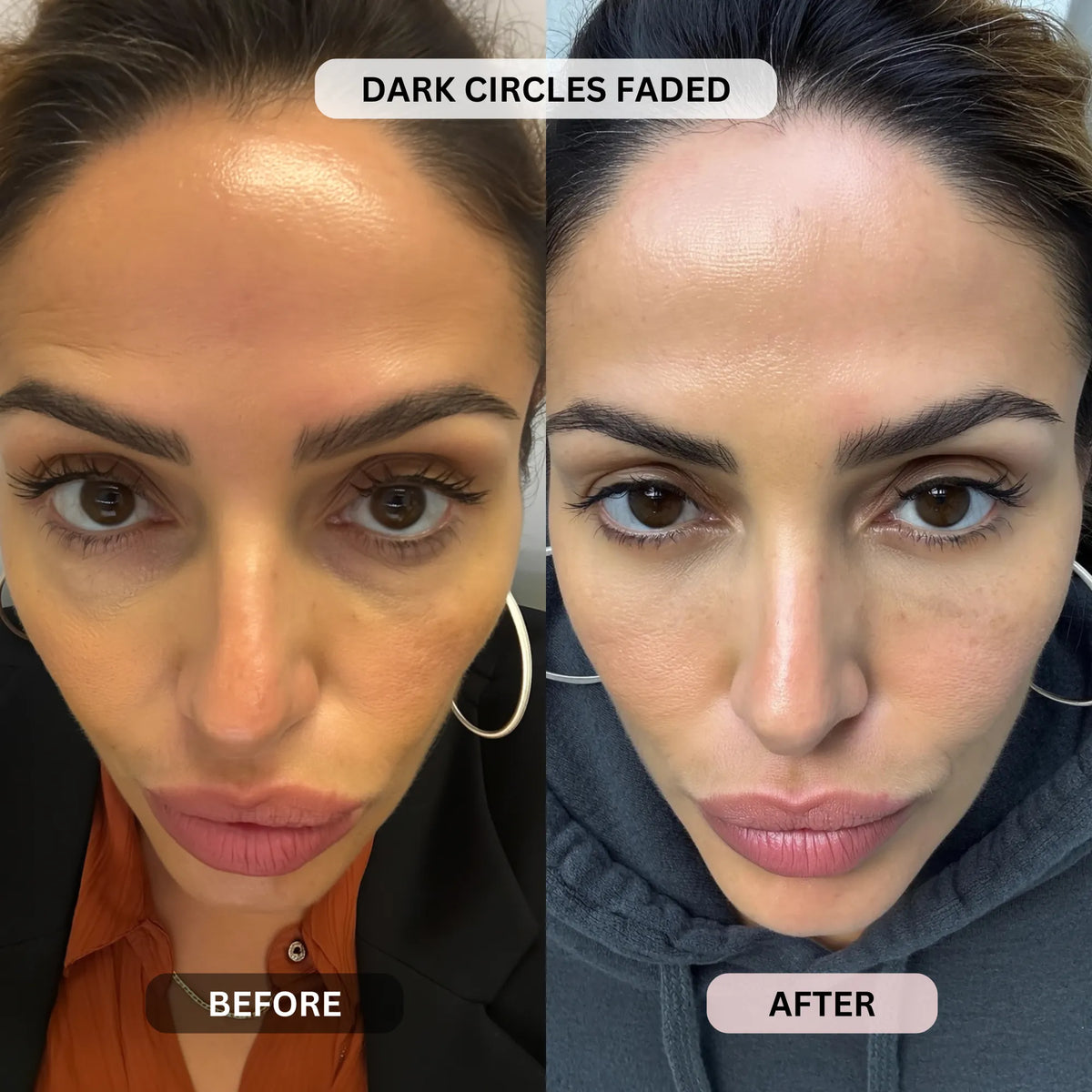Micro-Infusion System For Eye Bags & Dark Circles