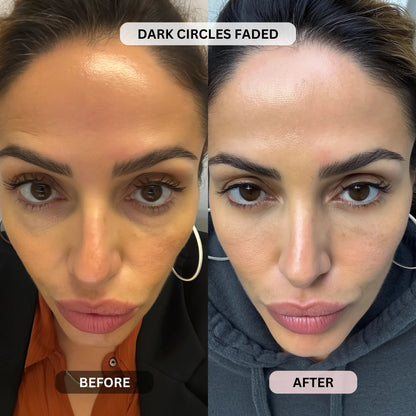 Micro-Infusion System For Eye Bags & Dark Circles