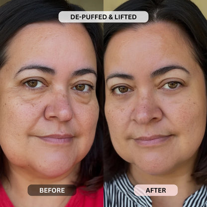 Micro-Infusion System For Eye Bags & Dark Circles