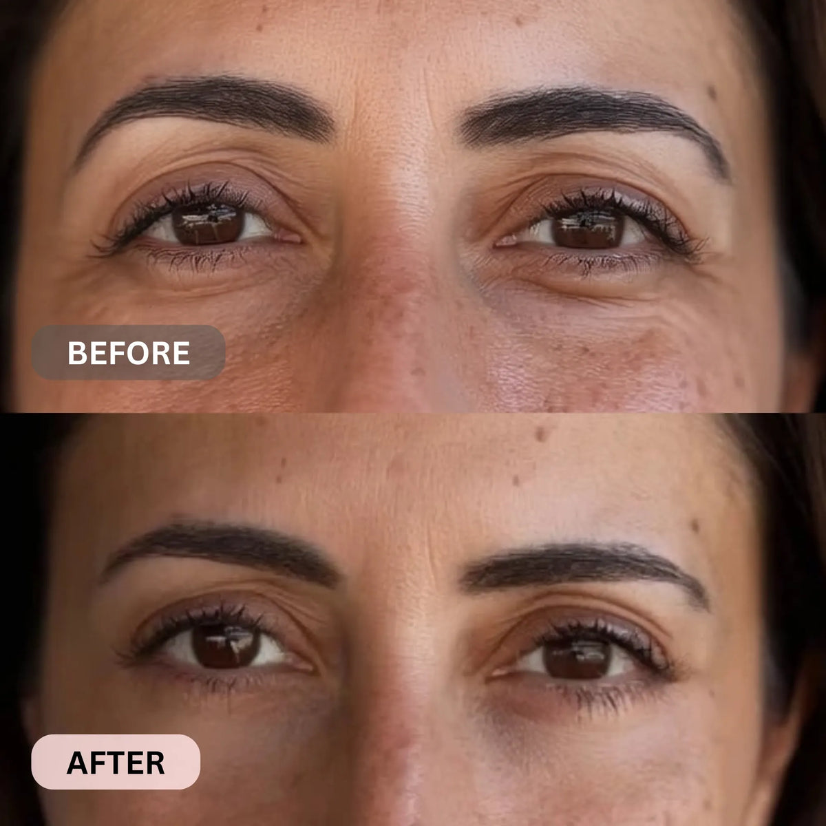 Micro-Infusion System For Eye Bags & Dark Circles