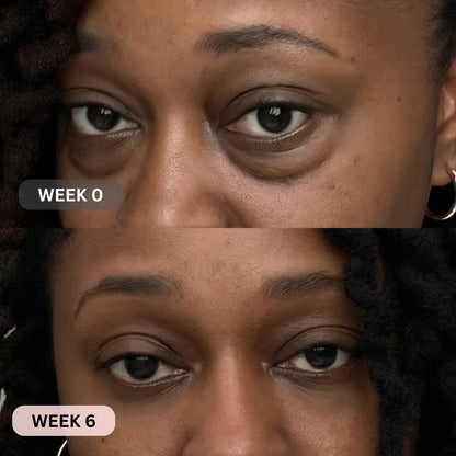 Micro-Infusion System For Eye Bags & Dark Circles