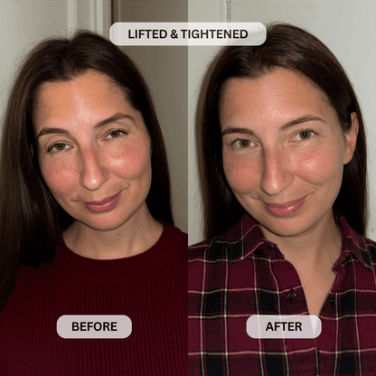 Micro-Infusion System For Hooded Eyelids