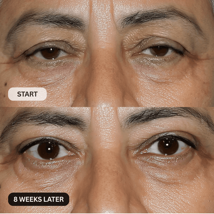 Micro-Infusion System For Hooded Eyelids