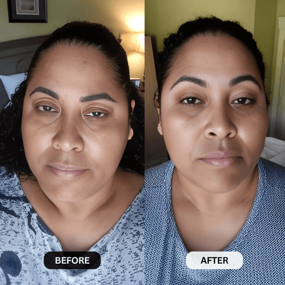 Micro-Infusion System For Hooded Eyelids