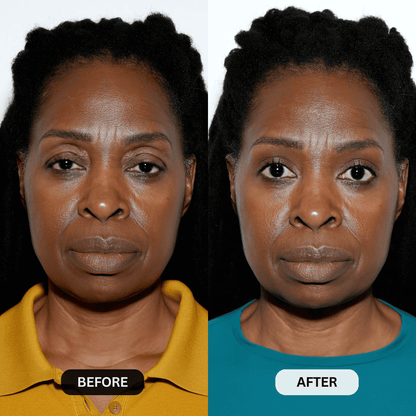 Micro-Infusion System For Hooded Eyelids