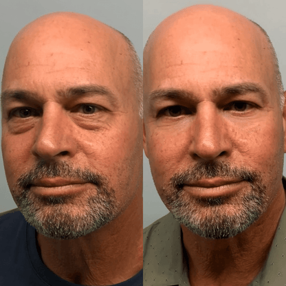 RevitalEyes® 2-in-1 Red Light Therapy + EMS To Erase Eye Bags for Men