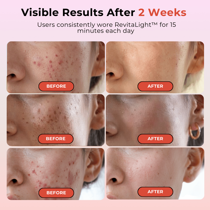 RevitaLight™ Red Light Therapy Face Mask