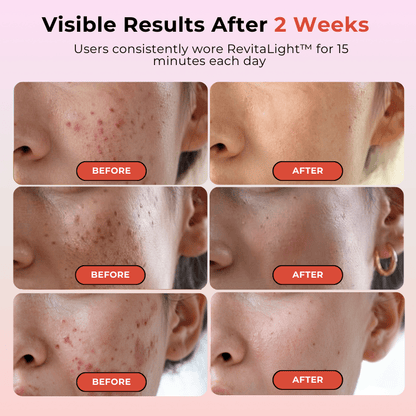 RevitaLight™ Red Light Therapy Face Mask