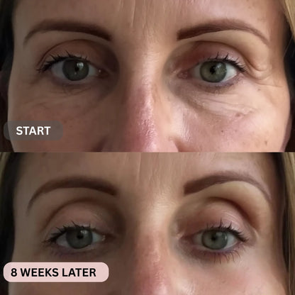 Micro-Infusion System For Eye Bags & Dark Circles