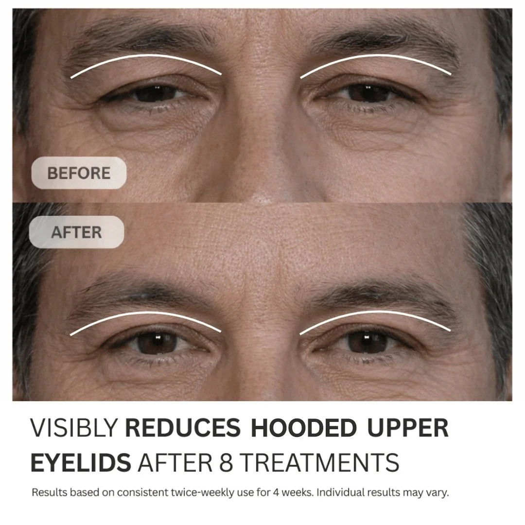 Micro-Infusion System For Hooded Eyelids for Men