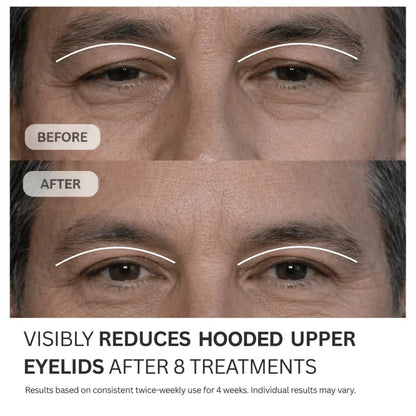 Micro-Infusion System For Hooded Eyelids for Men