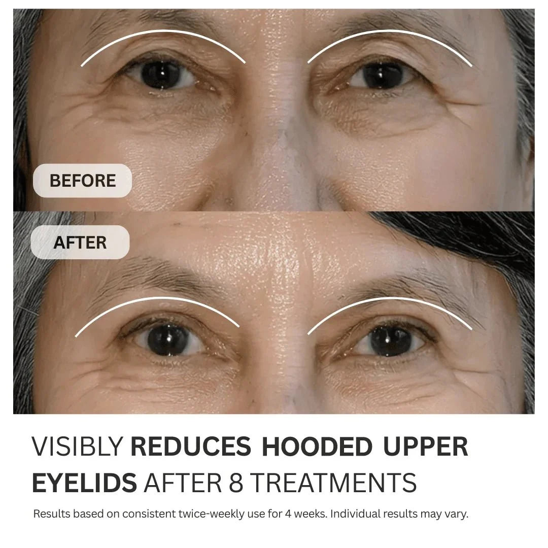 Micro-Infusion System For Hooded Eyelids